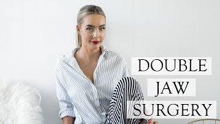 Corrective Double Jaw Surgery Experience | Post OP Swelling & Recovery