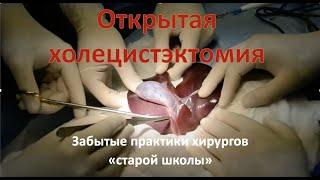 Открытая холецистэктомия: техника операции