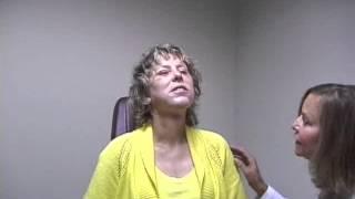 True Williams Face Lift Part 2 -Patient Recovery Testimonial