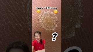 Что это ? #подолог #бородавки #мозоли