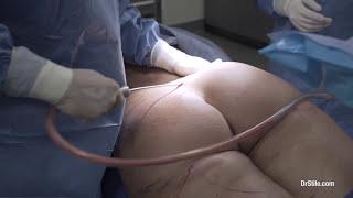 Dr. Stile - Brazilian Butt Lift Surgery Part 1