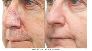 Anti Aging Treatments with Sciton BBL (Broadband Light) Laser