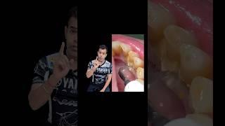 DENTIST Reveals SECRET to Cleaning Teeth with Ultrasonic Scaler
