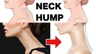 How to Fix a Neck Hump and Slim Face at Home