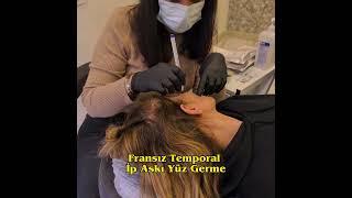 Fransız Askısı Deep lifting  #fransızaskısı #estetik #deeplift #aestheticistanbul1