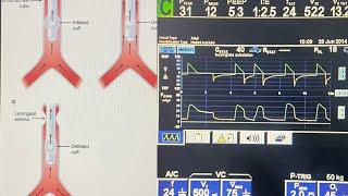 What is Cuff leak test? How to do and interpret it on ventilator