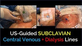 Ultrasound-Guided Subclavian Central Venous / Dialysis Line Insertion