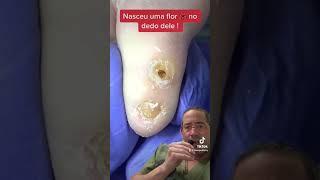 SHAVING A CALLUS CRATER#shorts