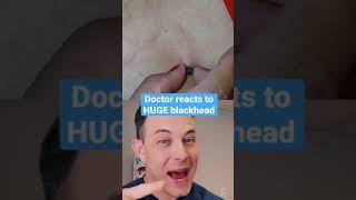 Biggest blackhead ever? | 208SkinDoc