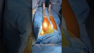 GUESS THE SURGERY! #drpankajwalecha #orthopedicsurgeon