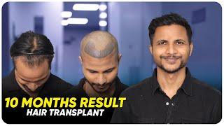 Hair Transplant in Madurai | Best Results & Cost of Hair Transplant in Madurai