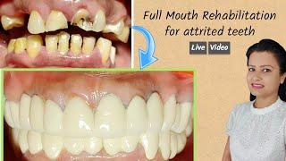 full mouth rehabilitation for attrited teeth | full mouth crowns preparation | Transformation - 3