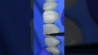 Dental motivation. Direct composite restoration teeth. Composite veneers #veneers #dentistry