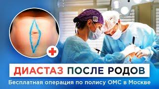 Как избавиться от диастаза после родов? Симптомы, причины, бесплатное лечение по ОМС