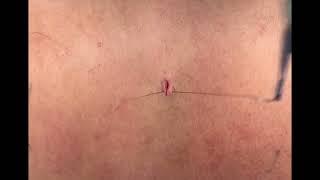 How to Suture Like a Plastic Surgeon Lession 5: Simple Interrupted Suture #medical #medicalstudent