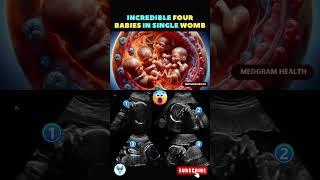 Beautiful 4 babies inside mom's womb  Fetal development | Baby Scan #shortsfeed #pregnancy #baby