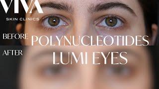 Lumi Eyes Polynucleotide PN  Injections 2024 | Before and Afters | Treat Dark Circles with Lumi Eyes