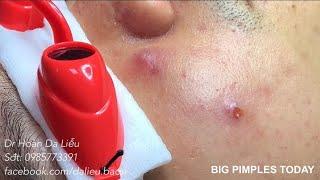 Những ca mụn nặng hôm nay| Dermatologist treating squeeze pimples,whitehead blackhead, pustule,anti