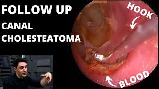 FOLLOW UP: Canal Cholesteatoma Patient Is Back