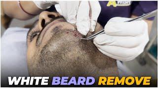 Say Goodbye to White Beards: Best Removal Technique | Awish Clinic | White Beard Remove