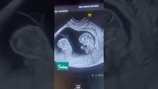 Ultrasound Scan️Twins#shorts #youtube #live #subscribe #viral #video #funny #twins#newborn#baby