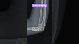 Elbow Surgery