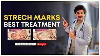 Best cream to remove STRETCH MARKS? | Dr Niranjan Samani