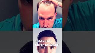 Month By Month Hair Transplant Result Turkey 4475 Grafts Sapphire FUE #hairtransplantturkey