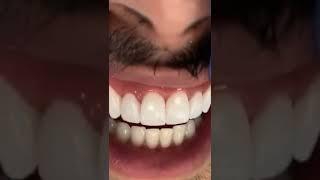 How we will cover the Tooth|Crowoning Of tooth|Tooth Crowning|Fixed Crown|Smile u want