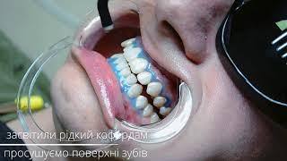 Отбеливание зубов системой Magic Smile "Ortom lounge dental clinic"