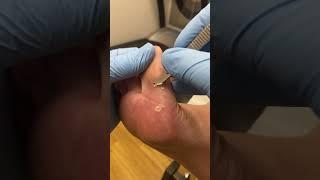 Thick Big toe callus removed by podiatrist in podiatry clinic