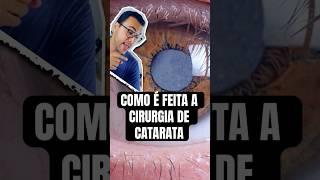 Como é Feita a CIRURGIA de CATARATA?