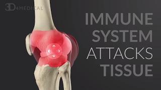 What is Rheumatoid Arthritis? | RA Awareness Day 2017