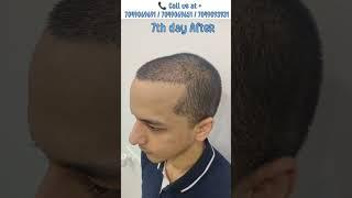 Hair transplant in indore | Best hair transplant cost in indore #shorts