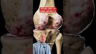 What Knee Arthritis REALLY Looks Like  #shorts