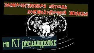 Злокачественная опухоль поджелудочной железы на расшифровке КТ брюшной полости с контрастированием