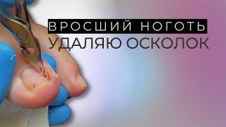 Удаление вросших ногтей + гной