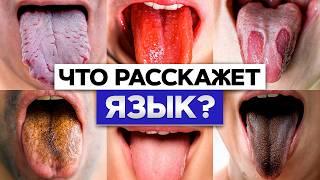 БЫСТРЫЙ диагноз по языку! / Как УЗНАТЬ болезни по языку?