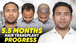 Hair Transplant in Hyderabad | Best Results & Cost of Hair Transplant in Hyderabad