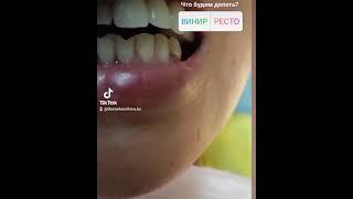 ХУДОЖЕСТВЕННАЯ РЕСТАВРАЦИЯ ЗУБА by doctor Tassilova  instagram: tassilova_clinic_kz