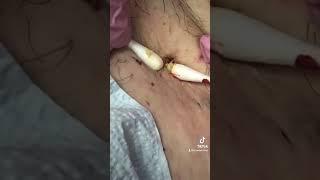 Large #blackhead w 3 openings