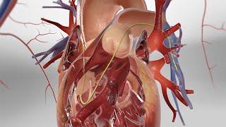 Pulmonary Artery Catheterization (3D Animation)