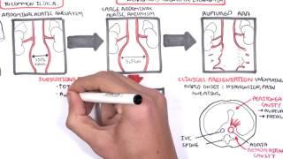 Abdominal Aortic Aneurysm - Summary