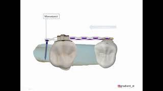 Минивинты в ортодонтии