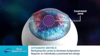 Astigmatism and Ortho-keratology - Can Orthokeratology correct Astigmatism? - Rose Optometrists