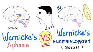Wernicke’s Aphasia vs. Wernicke's Encephalopathy - Neurology