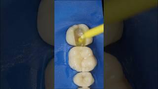 Dental motivation. Direct composite restoration teeth. #dental #dentistry