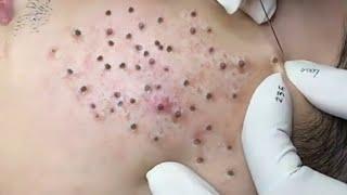 Relaxing Acne Treatment Everyday With Vu Quynh Mi Spa Blackheads Removal  Cystic Removal 2023  #008