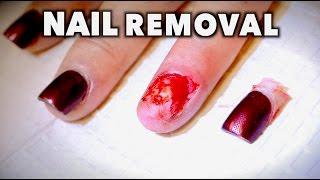 REMOVING MY WIFES FINGERNAIL...AGAIN! (Yikes) | Dr. Paul