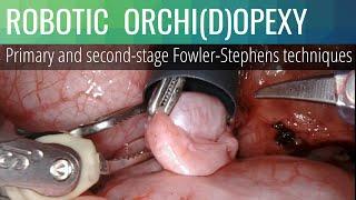 Robotic / laparoscopic orchidopexy (orchiopexy): primary and second-stage Fowler-Stephens technique